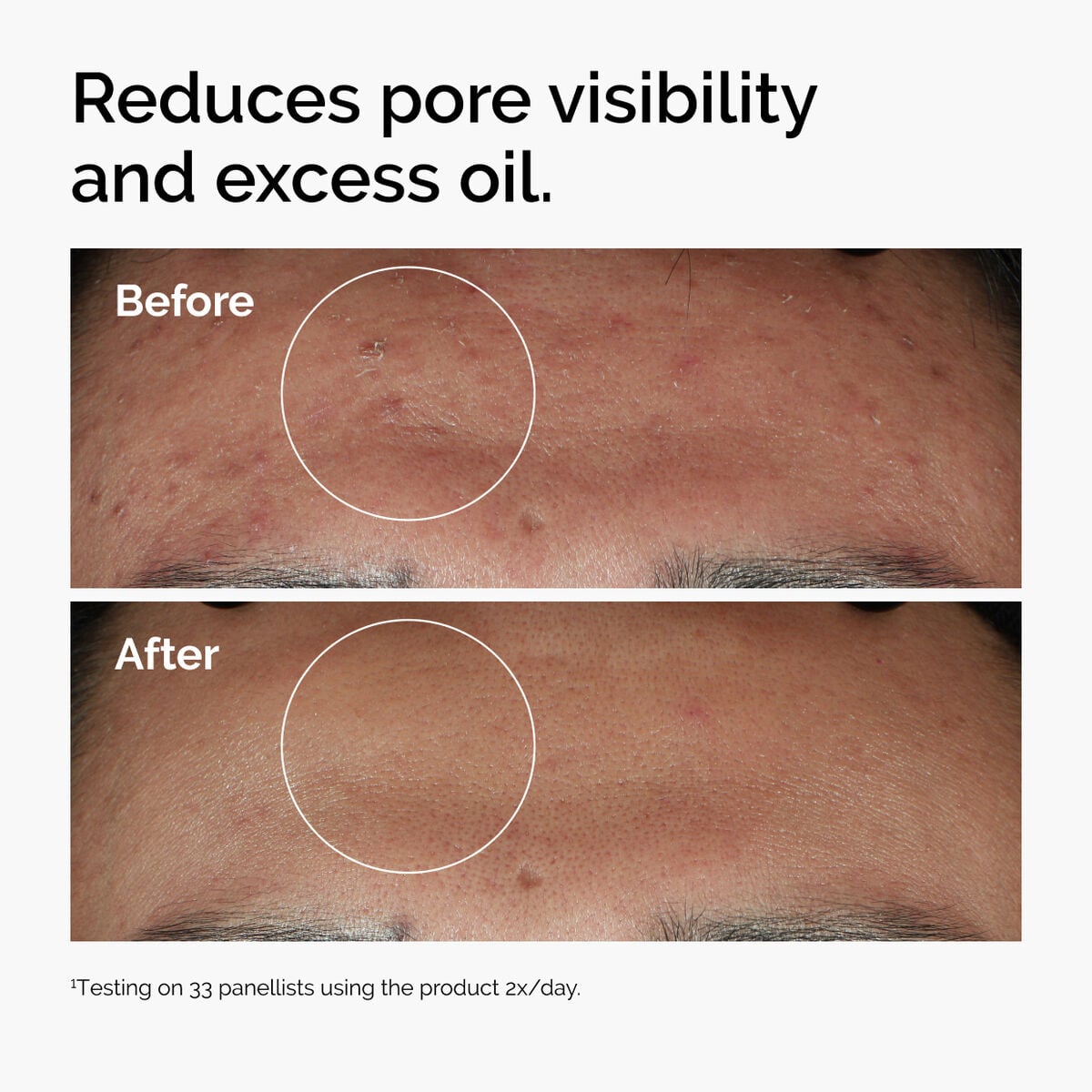 niacinamide-10-zinc-1-c5 ord-niacinamide-zinc-blemish-serum-before-after-pores.jpg