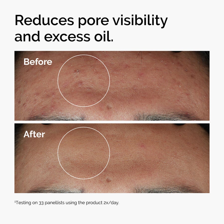 niacinamide-10-zinc-1-c5 ord-niacinamide-zinc-blemish-serum-before-after-pores.jpg