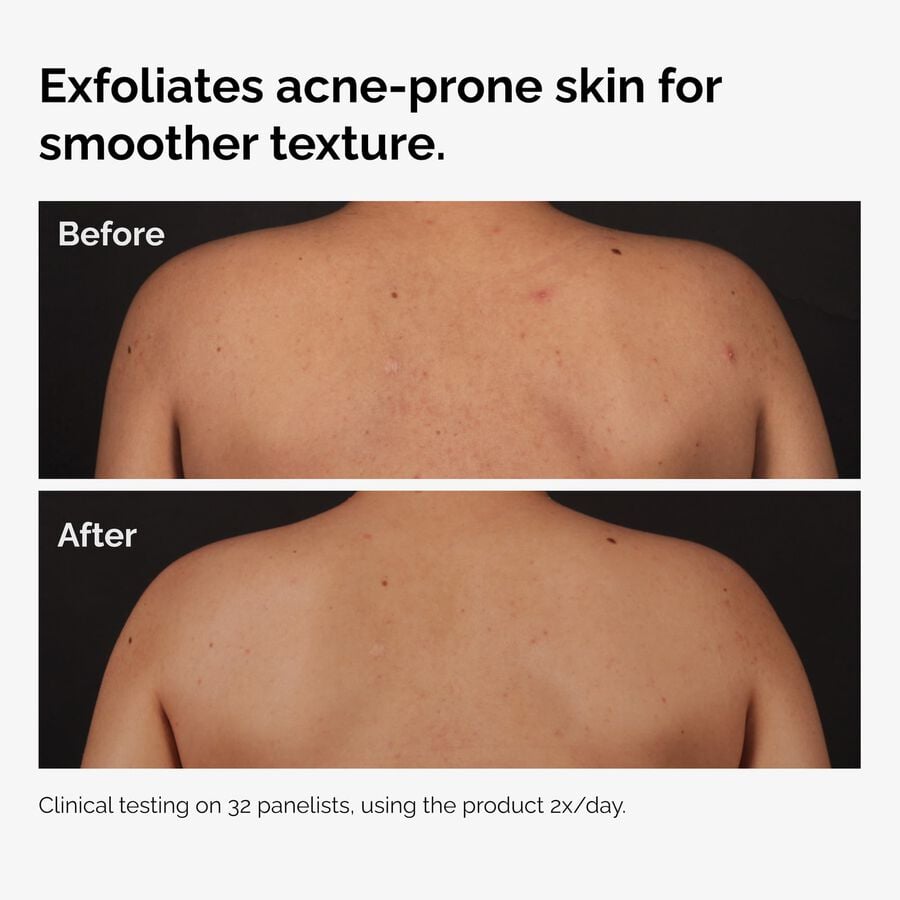 the-body-care-collection-a9 ord-salicylic-acid-body-serum-before-after-graphic-NA.jpg