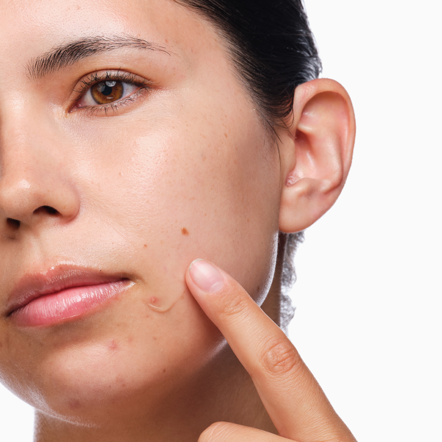 the-acne-set-o2 rdn-the-acne-set-application.png